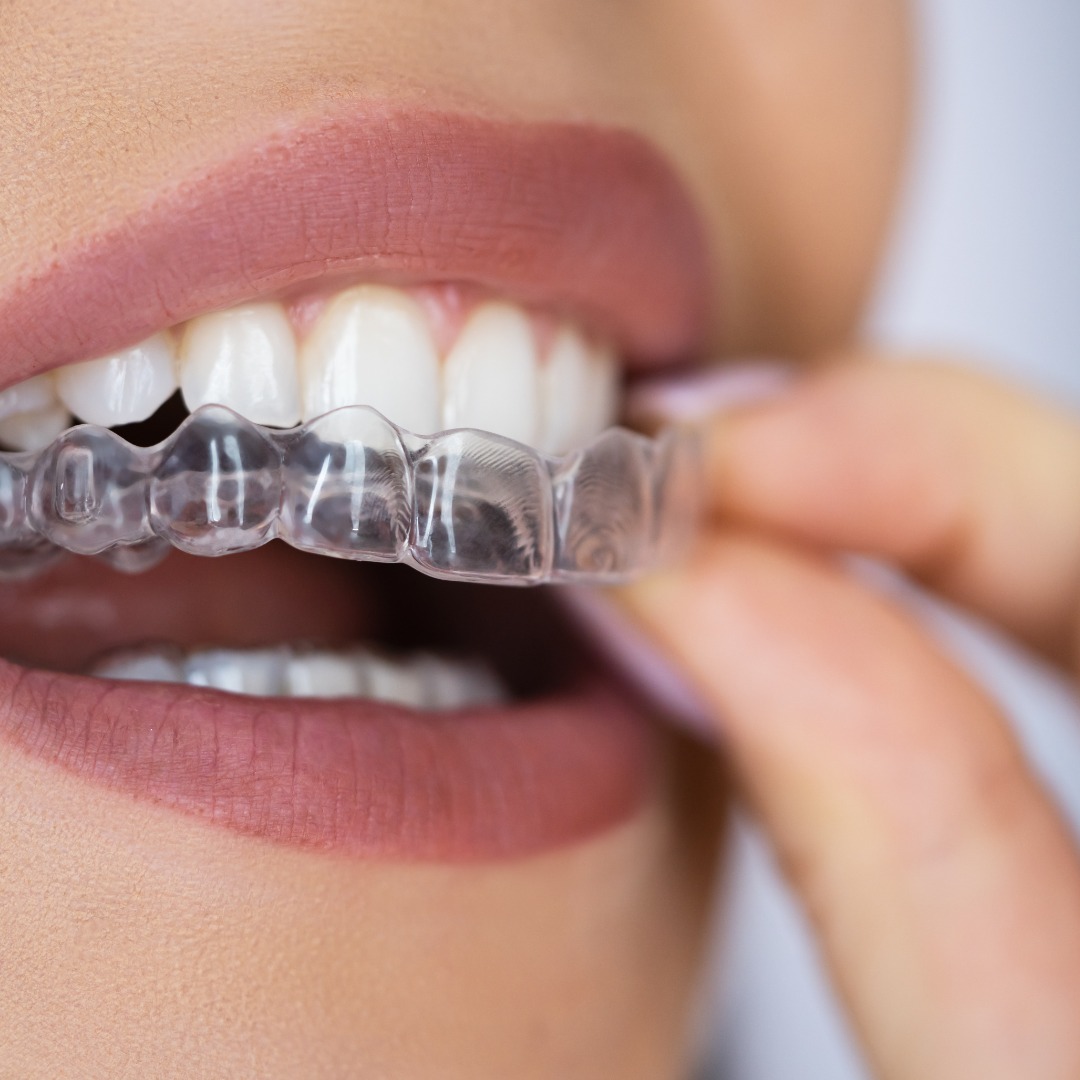 Mulher colocando alinhador transparente nos dentes, representando o início do tratamento ortodôntico estético.