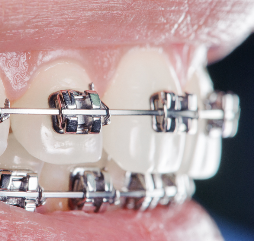 Aparelho ortodôntico fixo metálico ajustado aos dentes, representando o início do tratamento ortodôntico