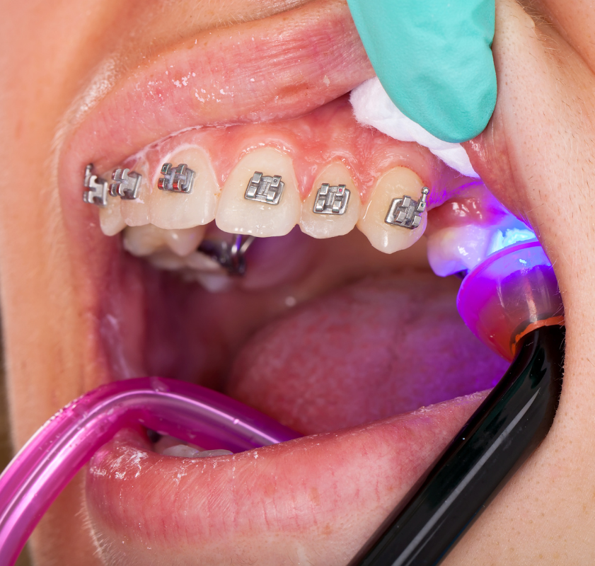 Close de procedimento odontológico com luz de fotopolimerização em aparelho ortodôntico fixo nos dentes inferiores