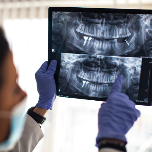 Dentista analisando radiografia panorâmica da arcada dentária do paciente, etapa essencial para planejamento do implante.