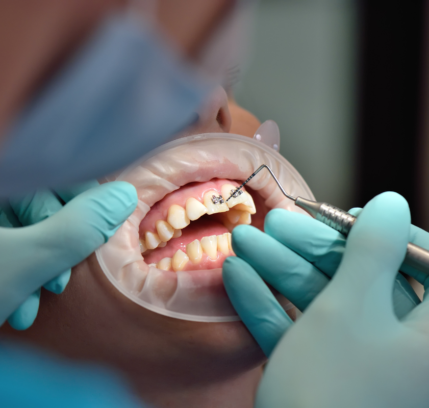 Dentista realizando a manutenção de aparelho ortodôntico em paciente, durante procedimento odontológico especializado