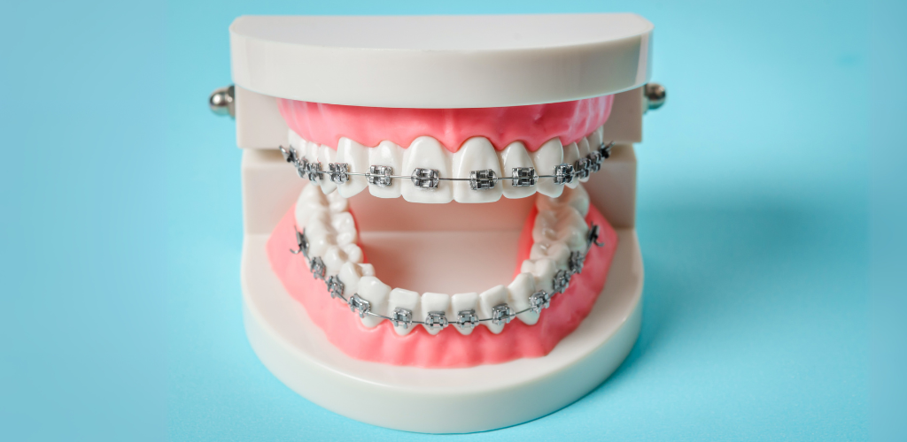 Modelo odontológico com aparelhos ortodônticos fixos, representando tratamento de alinhamento dentário em clínica especializada.