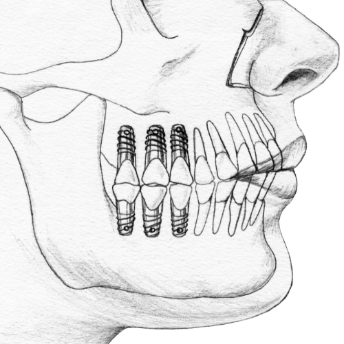 Ilustração anatômica em preto e branco mostrando a posição de múltiplos implantes dentários na arcada inferior.