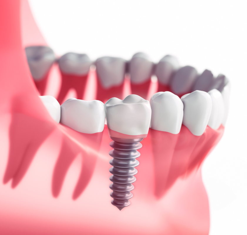 Ilustração de implante dentário fixado no osso da mandíbula, mostrando a estrutura e integração do pino com a prótese