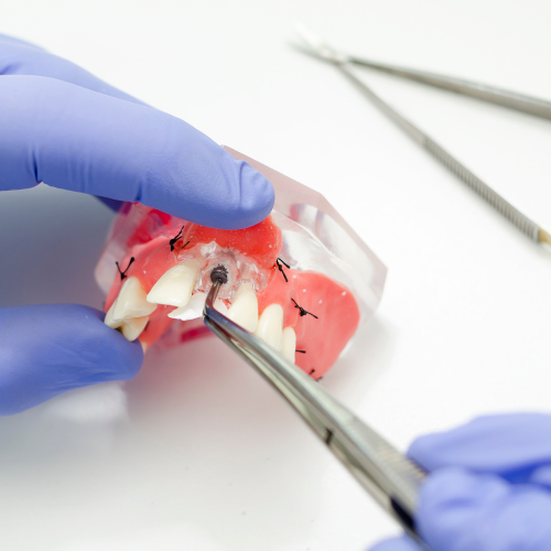 Mãos com luvas manuseando um modelo de implante dentário com pinça, destacando a explicação técnica do procedimento.