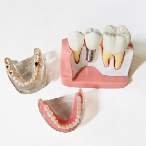 Modelo anatômico mostrando diferentes fases do implante dentário, com peças removíveis representando prótese, gengiva e mandíbula.