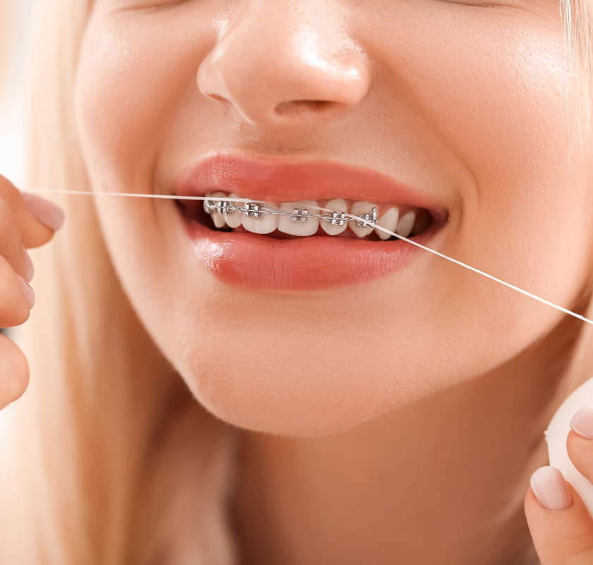 Mulher jovem sorrindo com aparelho ortodôntico metálico, demonstrando os resultados do alinhamento dentário