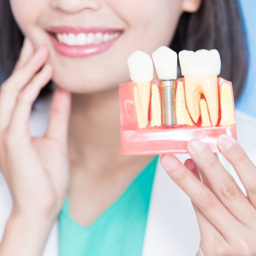 Mulher sorrindo e segurando um modelo de implante dentário, demonstrando confiança e saúde bucal após o tratamento.