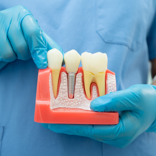 Profissional da saúde segurando modelo anatômico de implante dentário, demonstrando estrutura com pino, gengiva e coroa para explicação do tratamento.