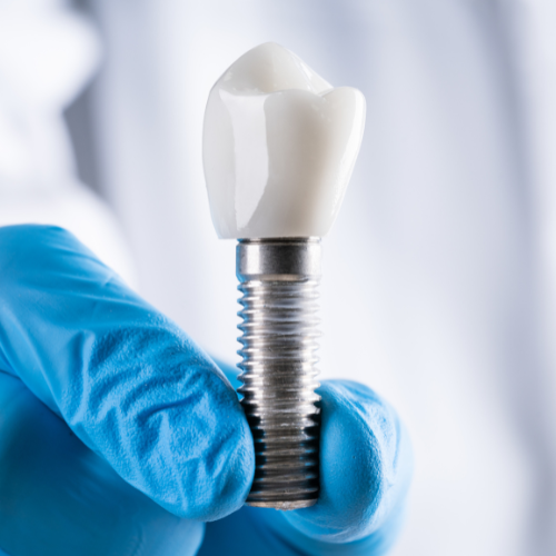 Profissional segurando um implante dentário metálico com luvas azuis, simbolizando tecnologia e precisão no procedimento.